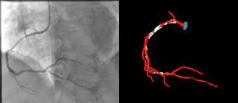 Στένωση στεφανιαίας αρτηρίας πριν την αγγειοπλαστική – μπαλονάκι και stent Θεσσαλονίκη