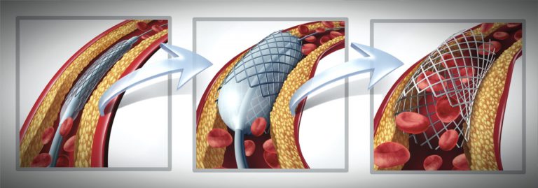 “Αγγειοπλαστική με stent στη Θεσσαλονίκη – σύγχρονη θεραπεία στεφανιαίας νόσου”