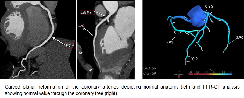Αναίμακτη στεφανιογραφία με FFR-CT – μη επεμβατική εκτίμηση ροής στα στεφανιαία αγγεία με αξονική τομογραφία