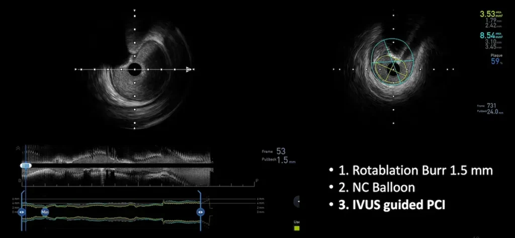 IVUS και βελτιστοποίηση αγγειοπλαστικής με stent