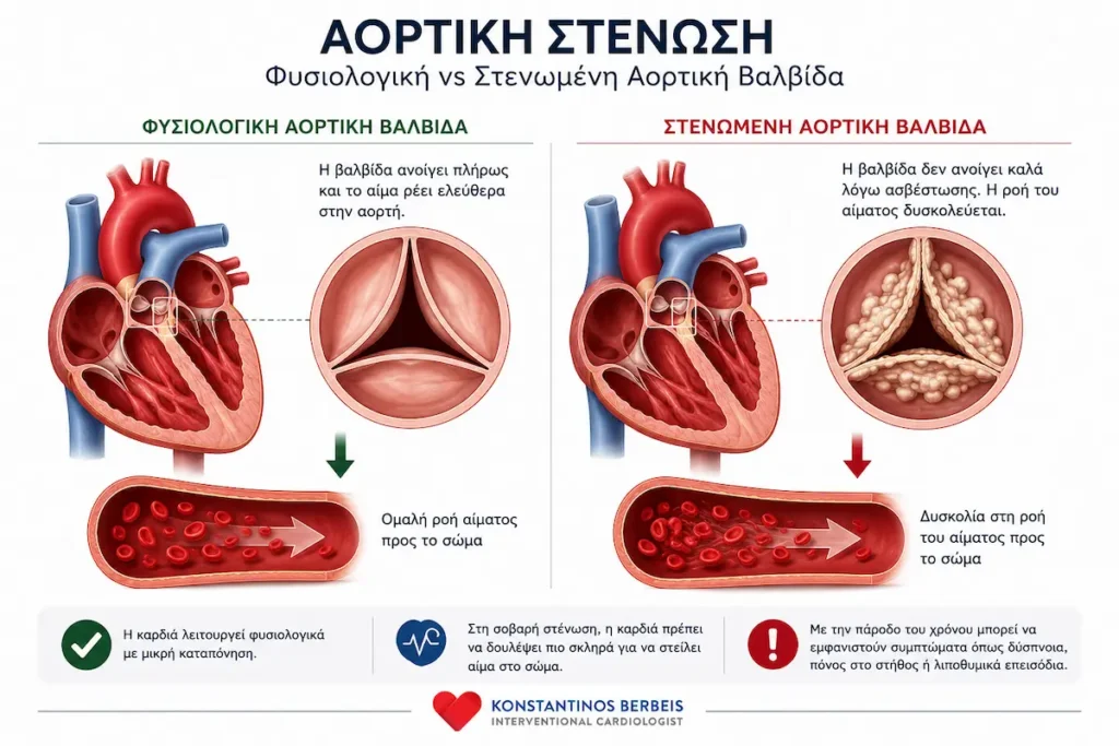 Φυσιολογική και σοβαρά στενωμένη αορτική βαλβίδα με σύγκριση της ροής του αίματος προς το σώμα